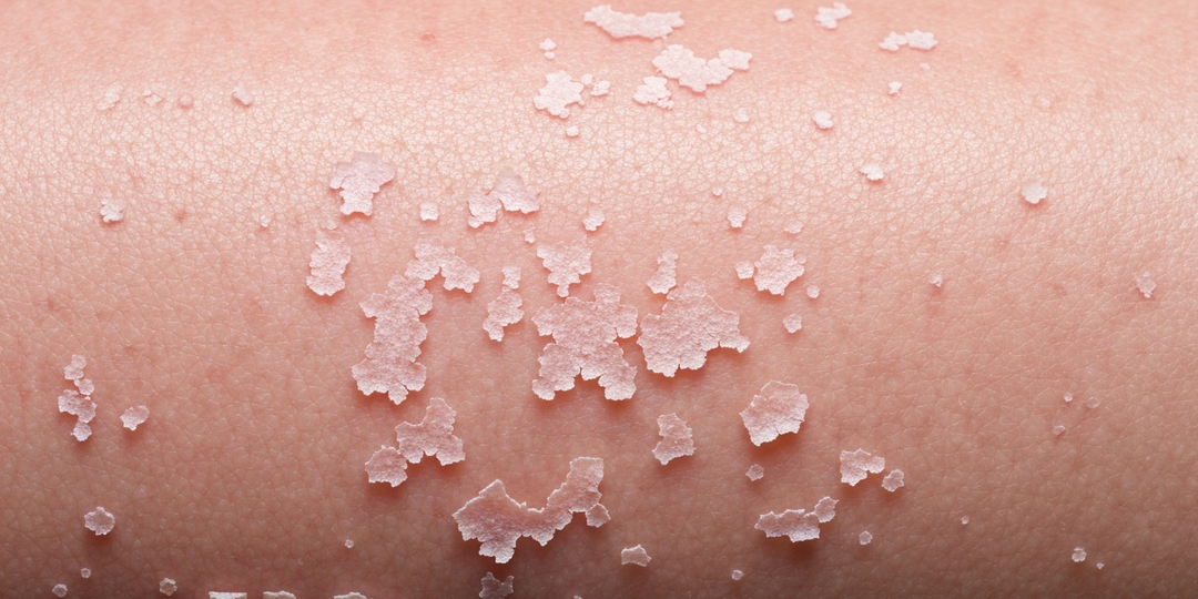 Эти участки кожи шелушатся не просто так