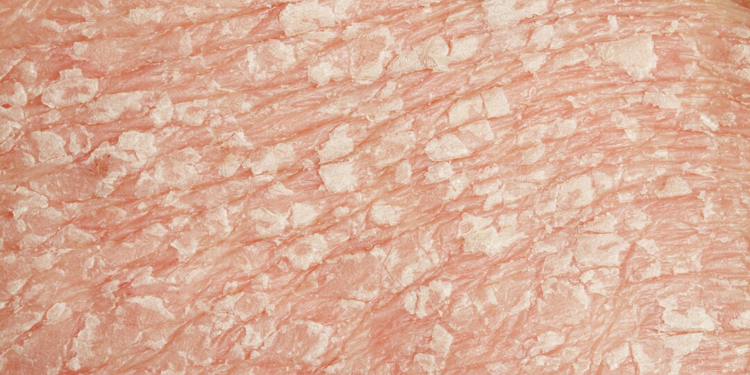 Псориаз может сопровождаться сильным шелушением