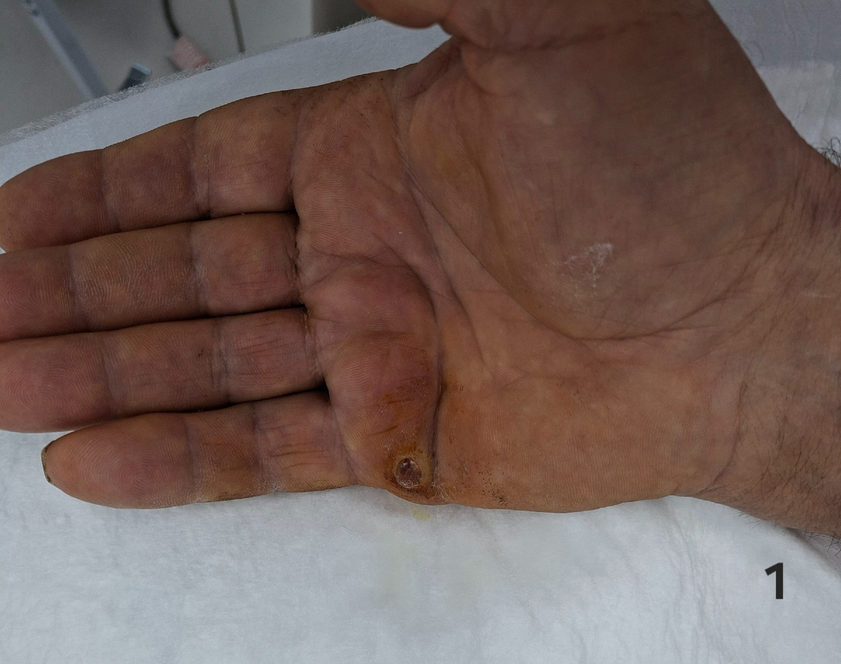 Вид гранулёмы кисти перед операцией.