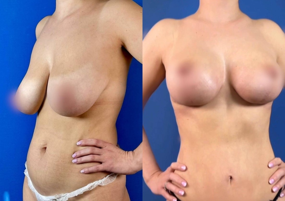 С моей пациенткой решили сделать LJ-подтяжку молочных желез без имплантов вместе с коррекцией фигуры (миниабдоминопластикой, липомоделированием живота). Такой результат спустя всего два месяца после операции