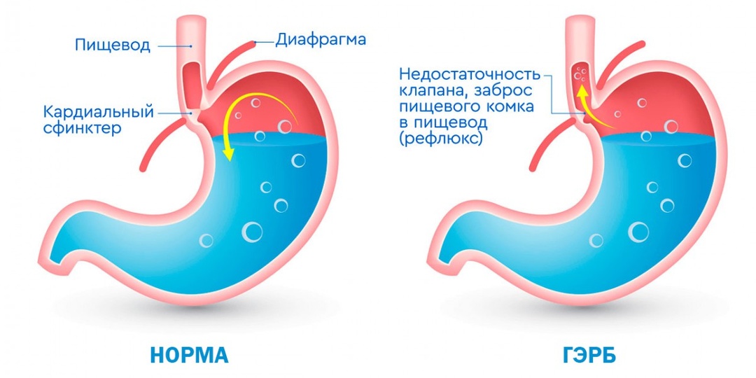 Частая изжога — когда это уже не желудок