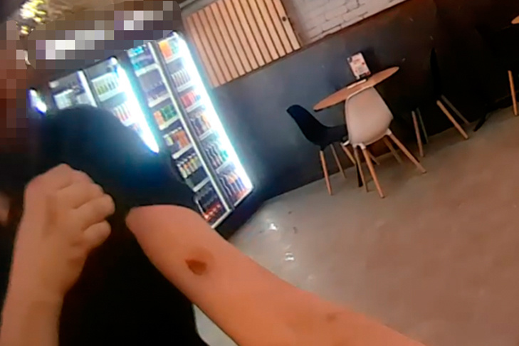    На руке мужчины остался весьма заметный след от укуса. Фото АБ Гвардия