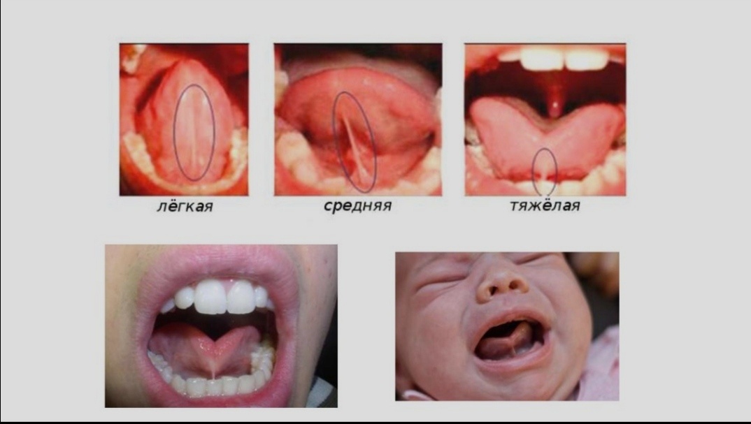Дело в том, что первая картинка это норма, а не лёгкая степень! 