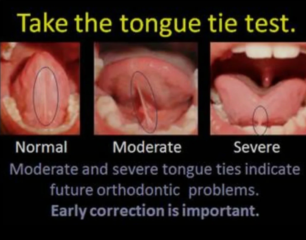 Normal: нормальная, Moderate: умеренная    Sever: серьёзная