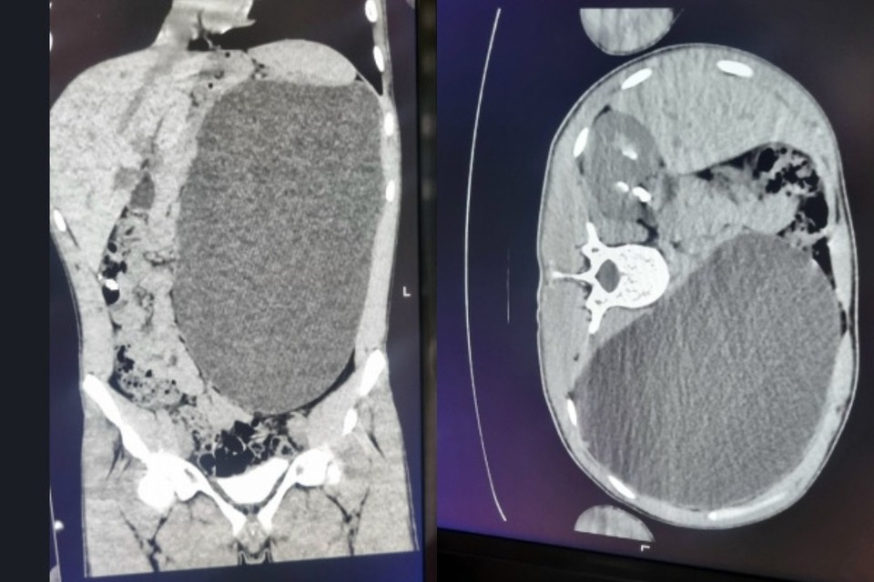 В Новосибирске во время профосмотра у 17-летнего парня выявили увеличение почки до размера пятилитровой банки. Фото: Минздрав Новосибирской области