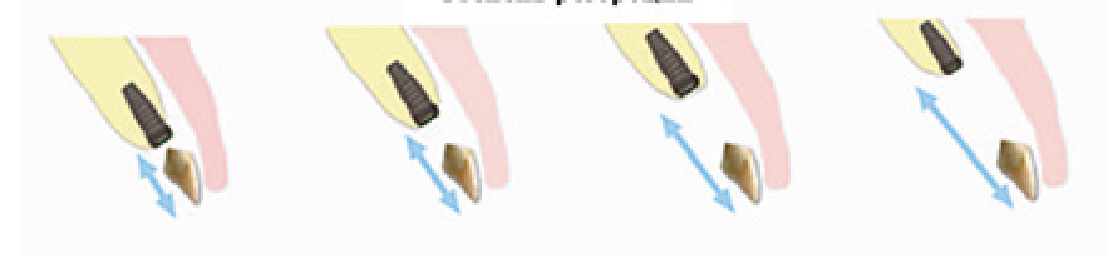 Рис. 1 Межокклюзионное пространство