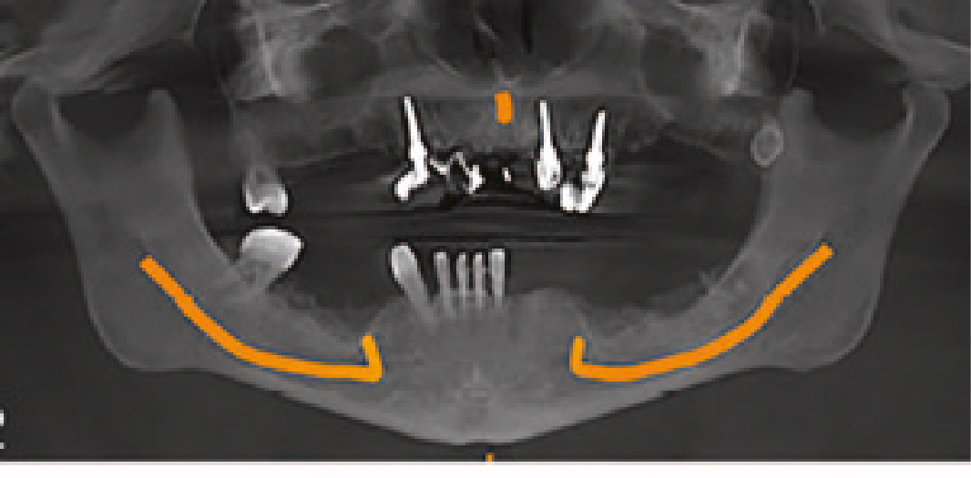 Рис. 2 Дооперационная ОПТГ, клинический случай 1