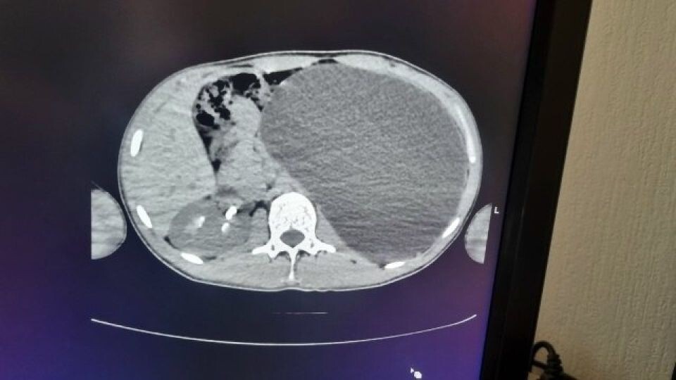    Почка достигла размеров пятилитровой бутылки. Источник: Министерство здравоохранения Новосибирской области