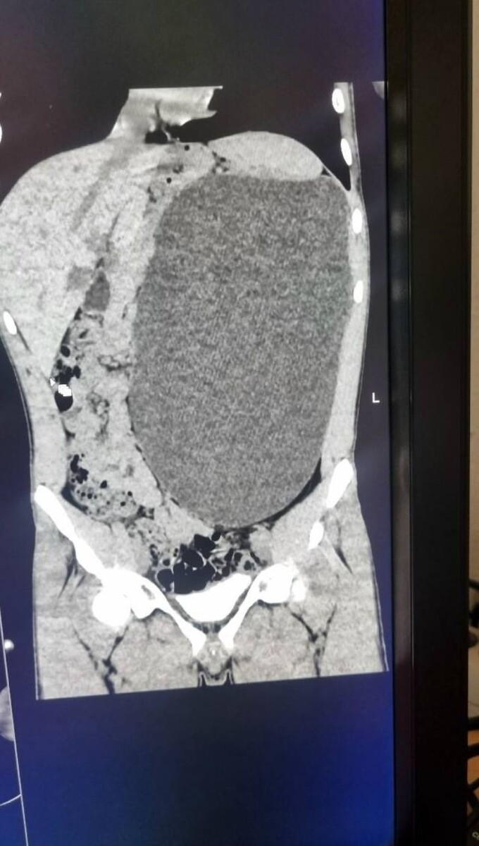    Почка достигла размеров пятилитровой бутылки. Источник: Министерство здравоохранения Новосибирской области