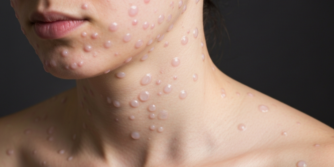 Эти пузырьки могут быть ветрянкой у взрослых