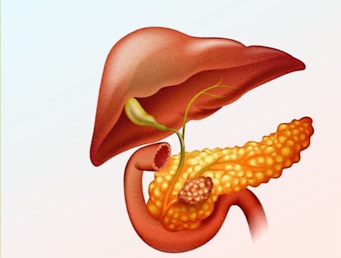 Подозрение на рак поджелудочной железы: что необходимо знать