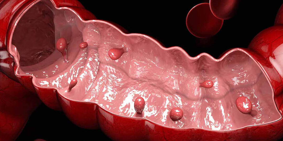 Непрошенные гости в кишечнике: что делать, если нашли полипы