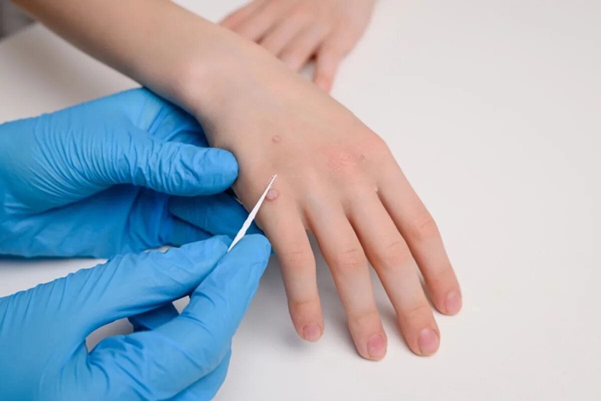    Врач Черепенин предупредил об опасности «неприличных» бородавок