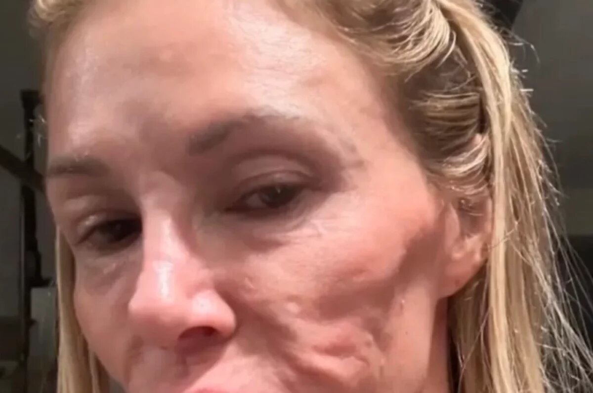    У звезды шоу «Настоящие домохозяйки Беверли-Хиллз» нашли паразитов в лице