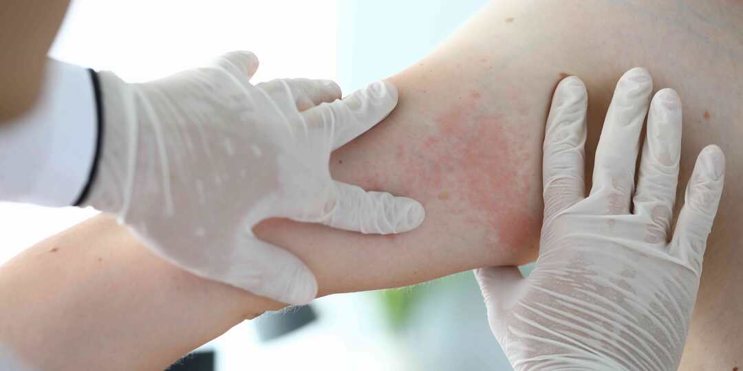 Так начинается кожная инфекция