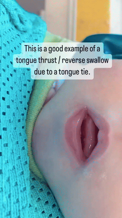 Пример рефлекторных выталкивающих движений языка и инфантильного типа глотания у младенцев. Видео взято из источника в образовательных целях: https://youtube.com/shorts/mUSIPzLauIE?si=kGdP3npMKhKjbg7V