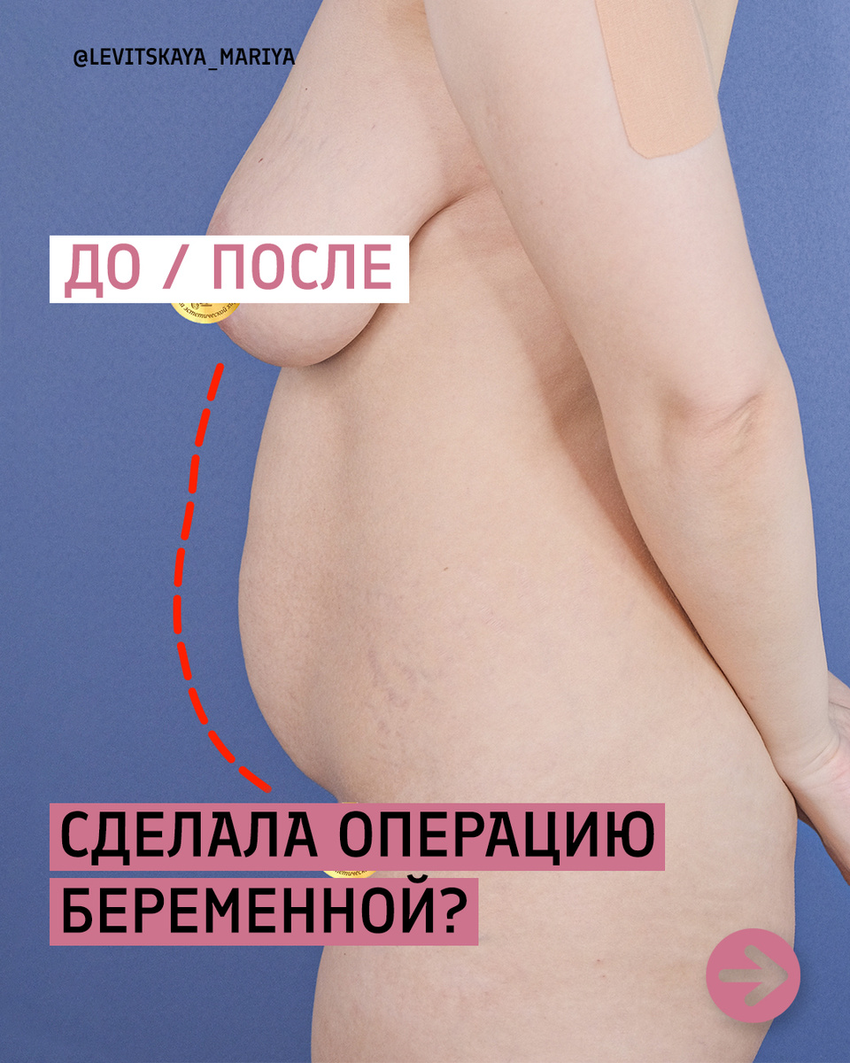 Абдоминопластика с ушиванием диастаза от пластического хирурга в Санкт-Петербурге Бурловой Марии Григорьевны клиника Абриелль 