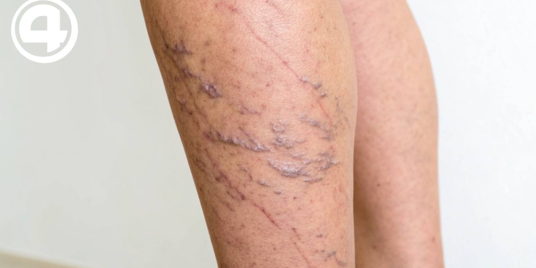 «Спорт может запустить варикоз»: сосудистый хирург предупредил об опасности гипернагрузок