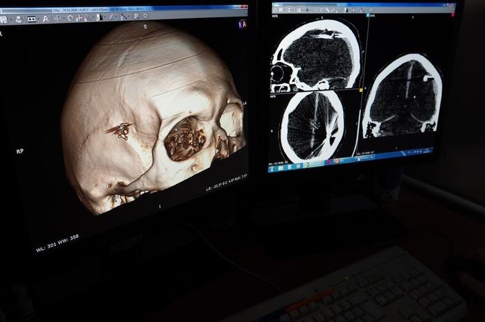 Нейрохирурги на Алтае спасли пациента с пулей. Фото © VK / КГБУЗ ККБСМП Барнаул