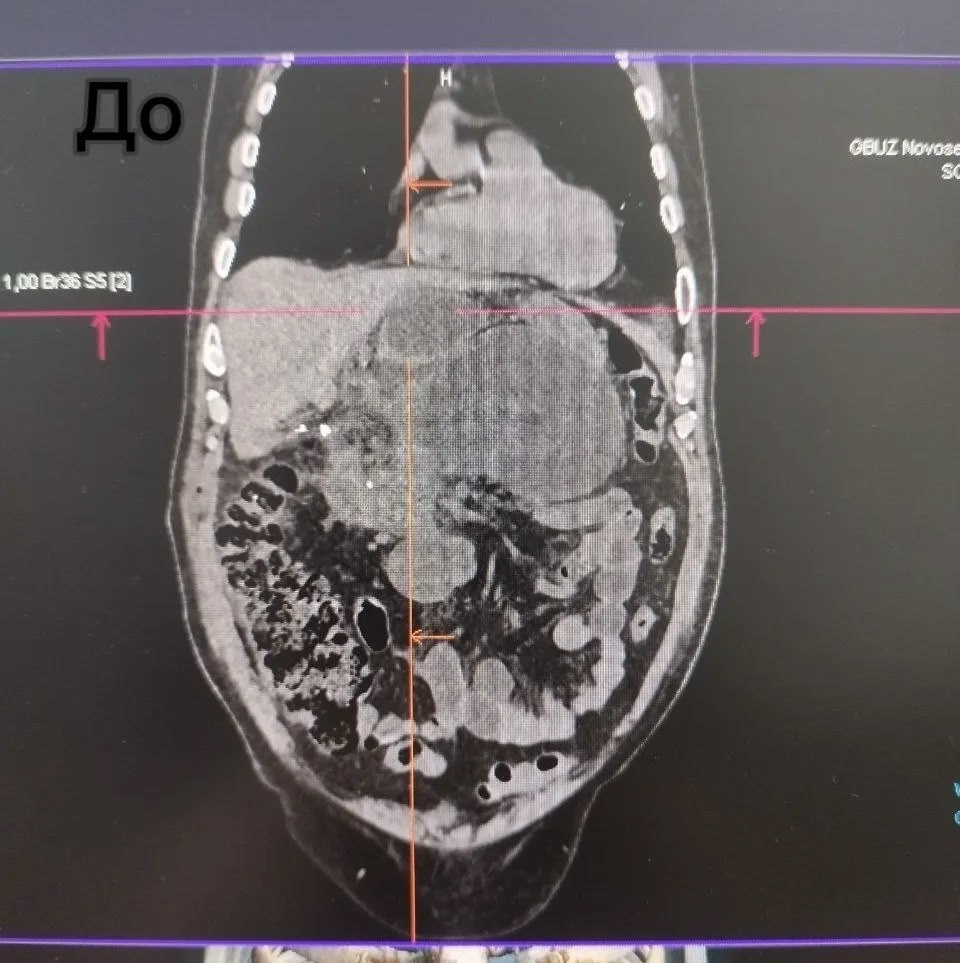     В Оренбуржье врачи спасли пациента с панкреонекрозом Оренбуржье
📷    В Оренбуржье врачи спасли пациента с панкреонекрозом Оренбуржье
