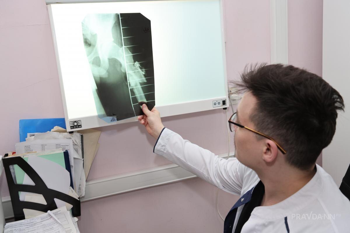    Перелом можно определить по сильной деформации конечности или другой области повреждения