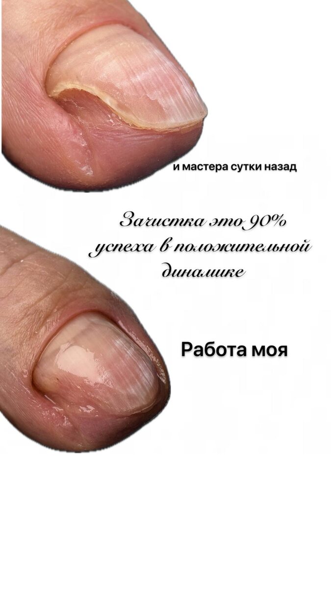 Профилактика грибковой инфекции у онкологических больных с нейтропенией
🩸В последние  несколько лет увеличилась заболеваемость системными микозами,  у больных с онкогематологическими заболеваниями. 
👀В связи с этим  важно знать о профилактики этих инфекций.
⛑️Кому будет интересно могу прикрепить ссылки на научные источники 
Помните доверять можно только доказательной медицине 
🍄у онкологических больных с возрастающей частотой появляются инфек-
ции, связанные с грибами: Penicillum, Fusarium spp., Aspergillus spp., Cripto-
соси и другие. 
🧫Дрожжеподобные грибы могут обсеменять все органы и ткани организма онкологического больного.
 🦠Споры аспергилл находятся в воздухе жилых помещений, поэтому необходимы меры по его очистке. Обычно в отделениях трансплантации костного мозга используются НЕРА-фильтры и химическая Дизинфекция позволяющие высокоэффективно удалять пыль и споры грибов из поступающего в палаты воздуха
🧬Споры Грибов  трудно избежать, потому что они являются естественной частью окружающей среды. Грибы живут на открытом воздухе в почве, на растениях, деревьях и другой растительности. Они также находятся на многих поверхностях внутри помещений и на вашей коже. 
💉Тем не менее, у вас может быть несколько способов снизить вероятность заражения, включая серьезную грибковую инфекцию.
🚨Важно понимать , что паниковать не нужно и если иммунитет снижается то заражение может произойти быстрее и активнее , чем когда ваш иммунитет активен и силен 
📉очевидно что здоровее крепче не становиться и каждое поколение слабже , поэтому меры профилактики нужно знать каждому 
🥼Помните ваше здоровье зависит только от вас 
🦶Кому интересен расширенный гайд по профилактике от грибка ногтей и стоп , ставьте плюсик
🤨Посмотрите реальные фото 
«до/после» лечения
📱 Москва, ул. Мнёвники, 13
📱 8(985)489-45-86 
📱  @g2f_center
📱 g2f.ru
📱 https://max.ru/podologeva

