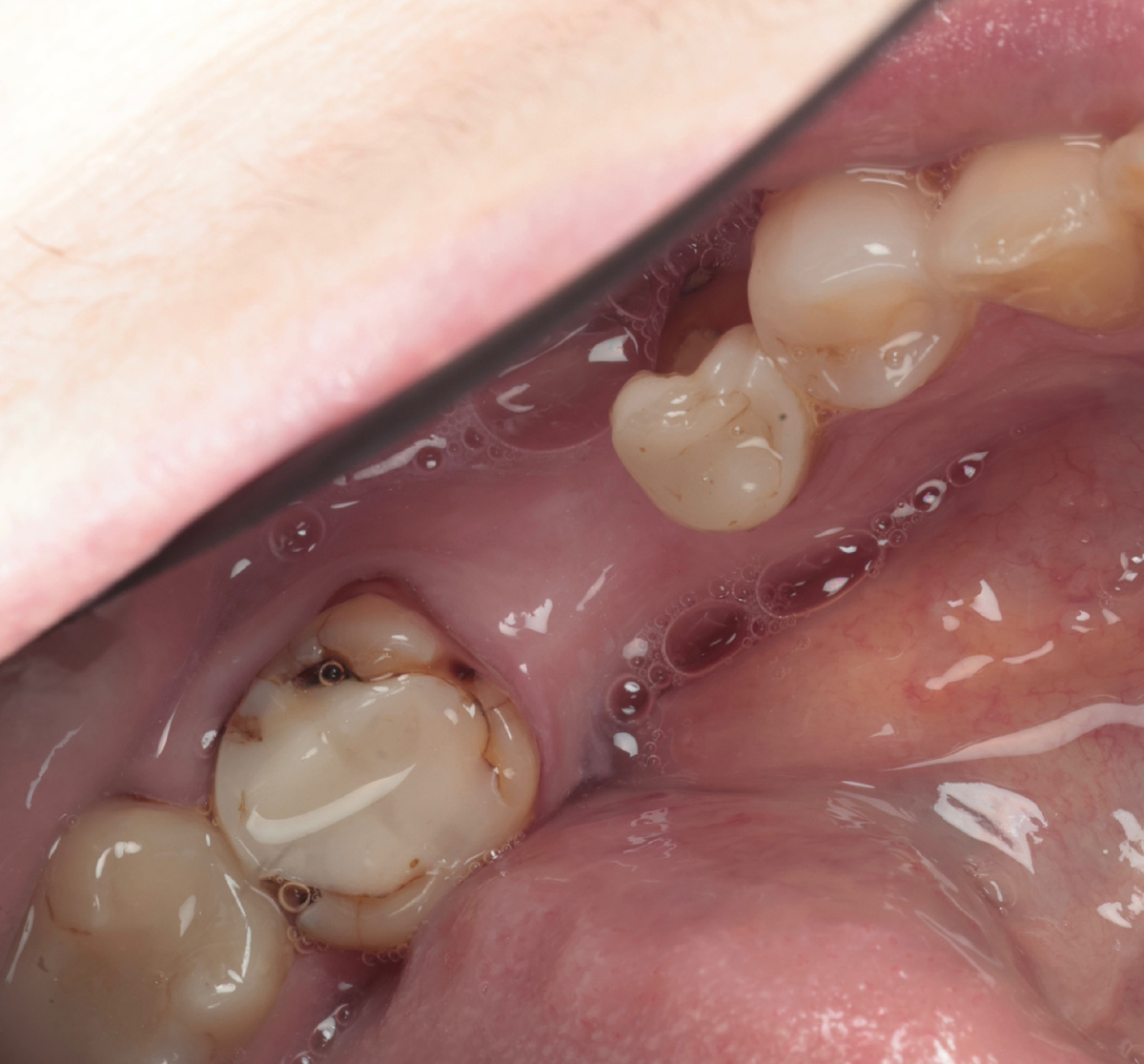 Состояние зубов до