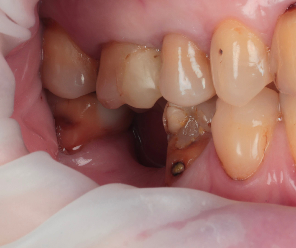 Фото до - щёчная сторона