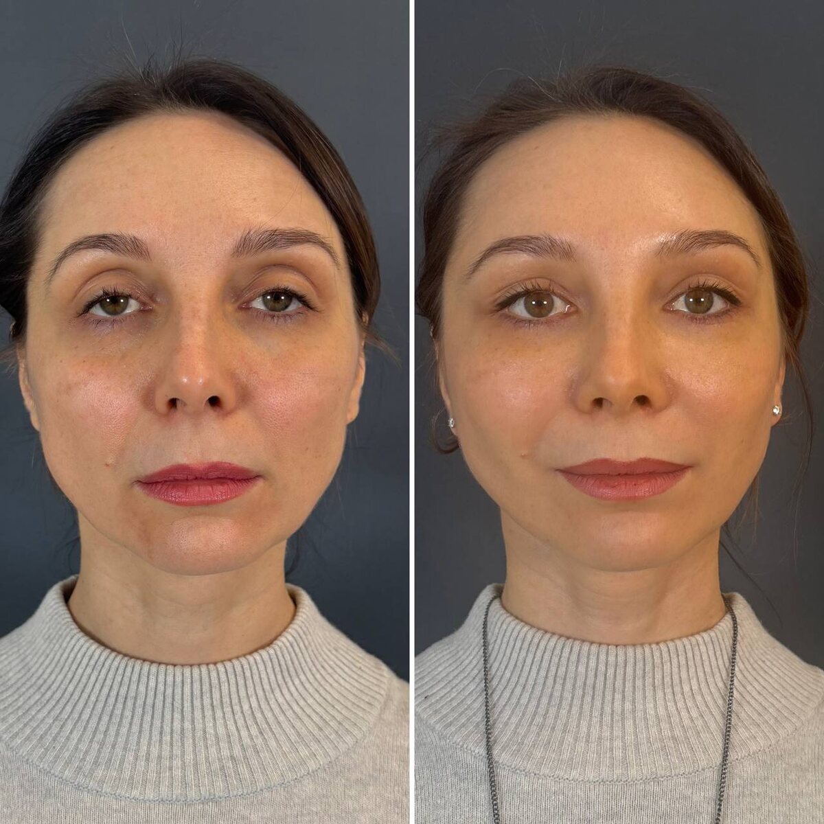 Эндоскопический лифтинг лица: 1 месяц после операции. Хирург Остринская Т. В.