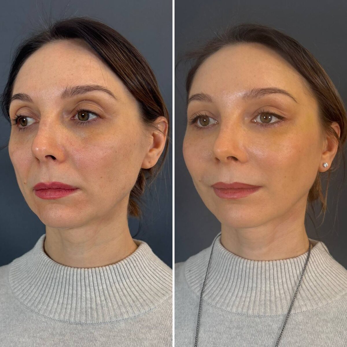 Эндоскопический лифтинг лица: 1 месяц после операции. Хирург Остринская Т. В.