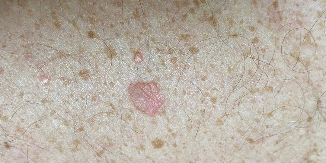 Плотная бляшка на коже — что может скрываться за этим