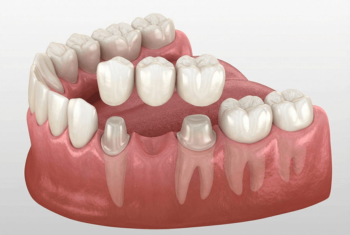 Потеряли зуб и не знаете, чем его заменить? Два главных варианта: мостовидный протез (мост) и имплант. Оба восстанавливают улыбку и жевание. Но работают по-разному и стоят по-разному. Разбираемся, в чем отличия и когда что подходит.
