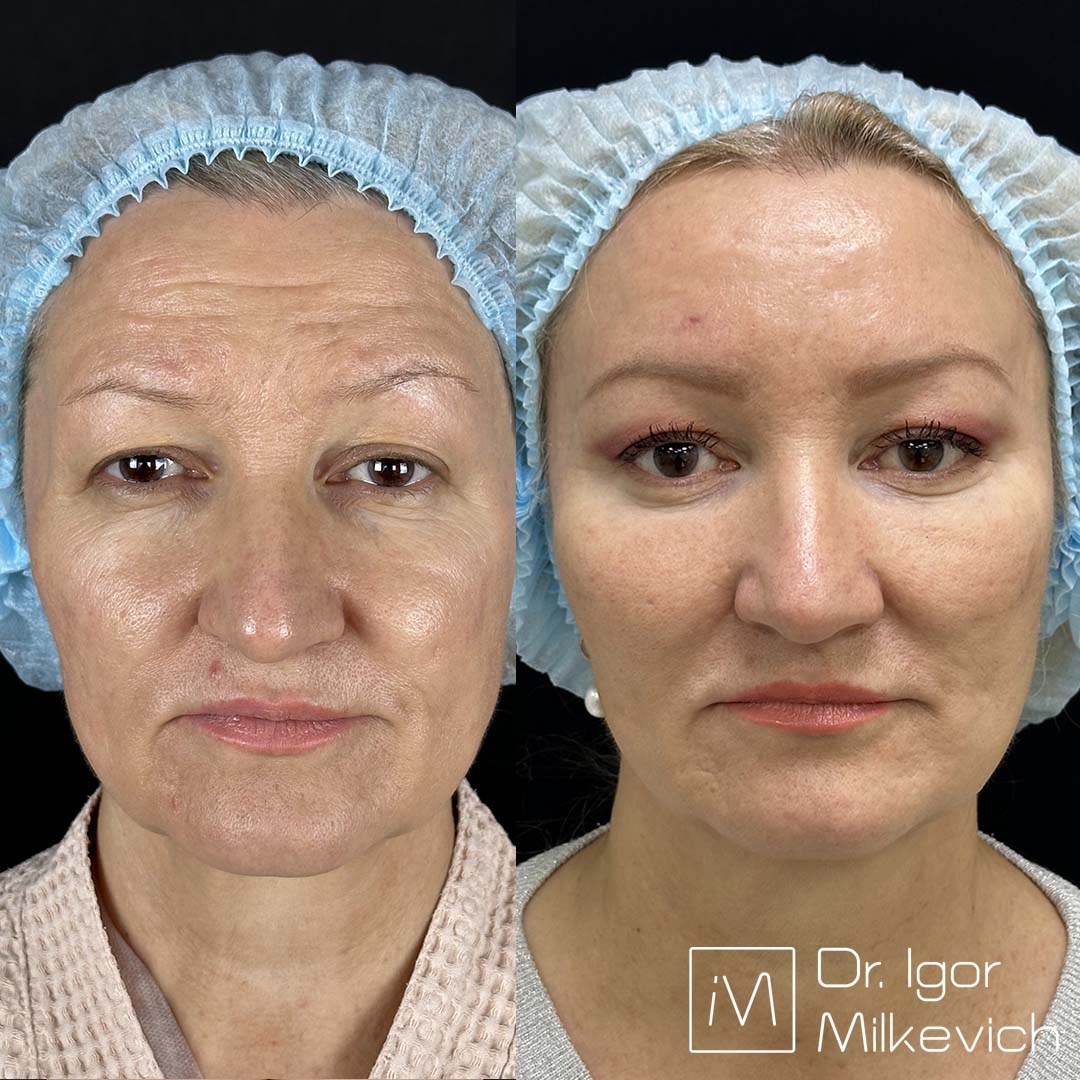 Месяц после подтяжки верхней и средней трети лица