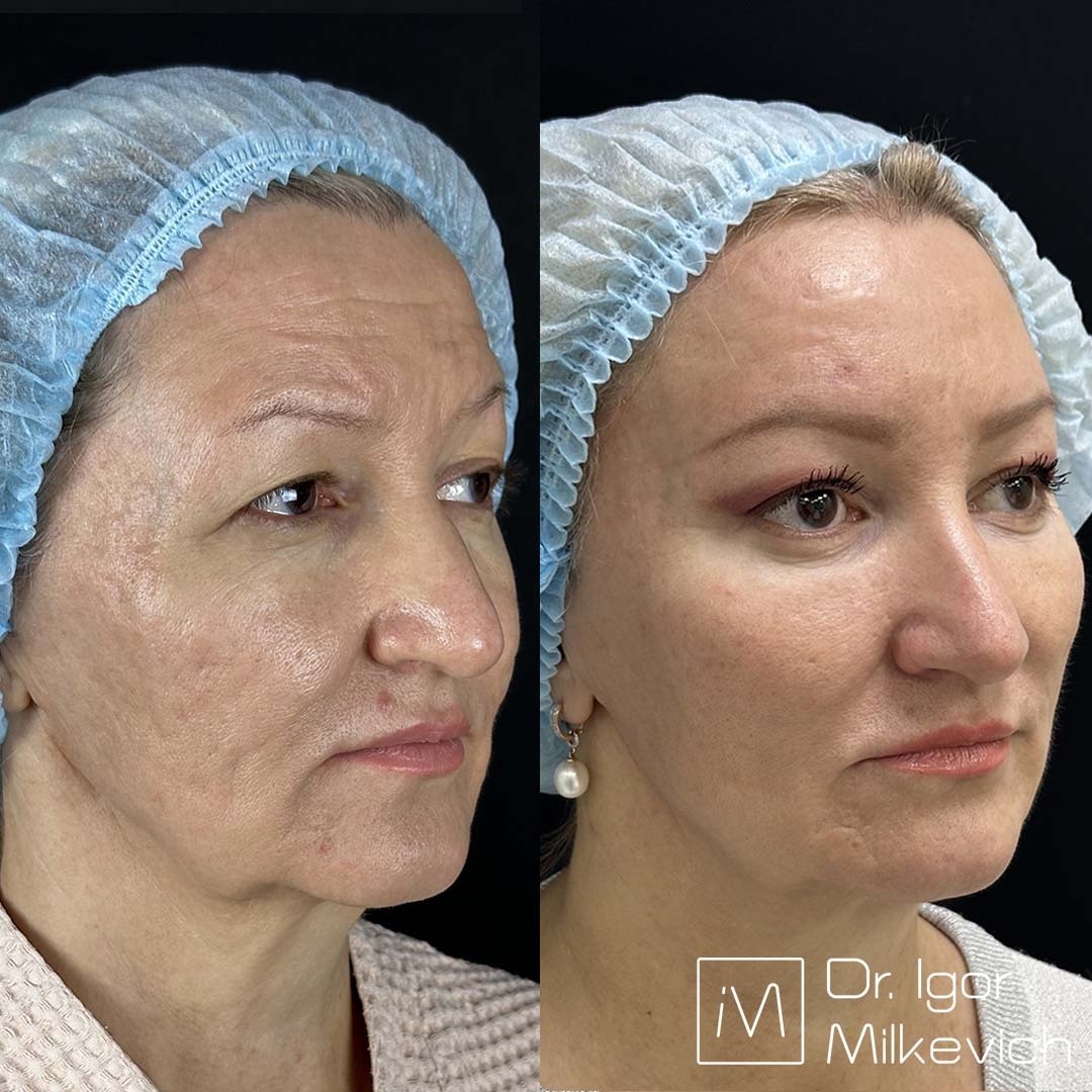 Месяц после подтяжки верхней и средней трети лица