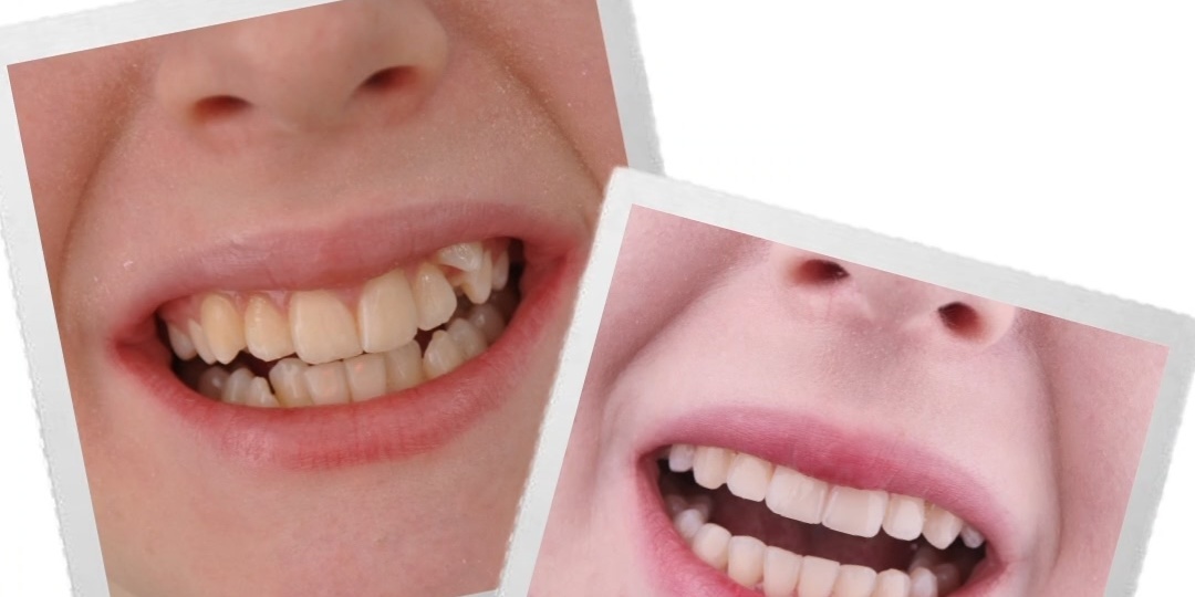 Улыбка, которую долго ждали: история сложного ортодонтического лечения с идеальным финалом