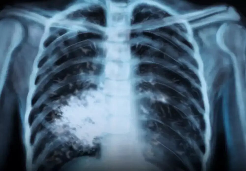 Попкорновое легкое. Фото: СоцСети.