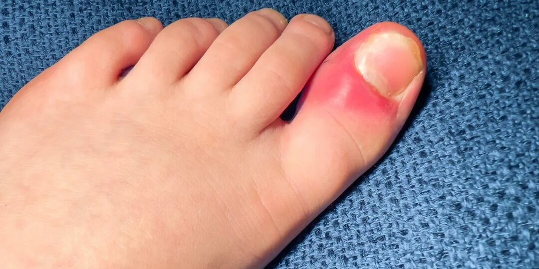 Вросший ноготь. Почему получается и что делать