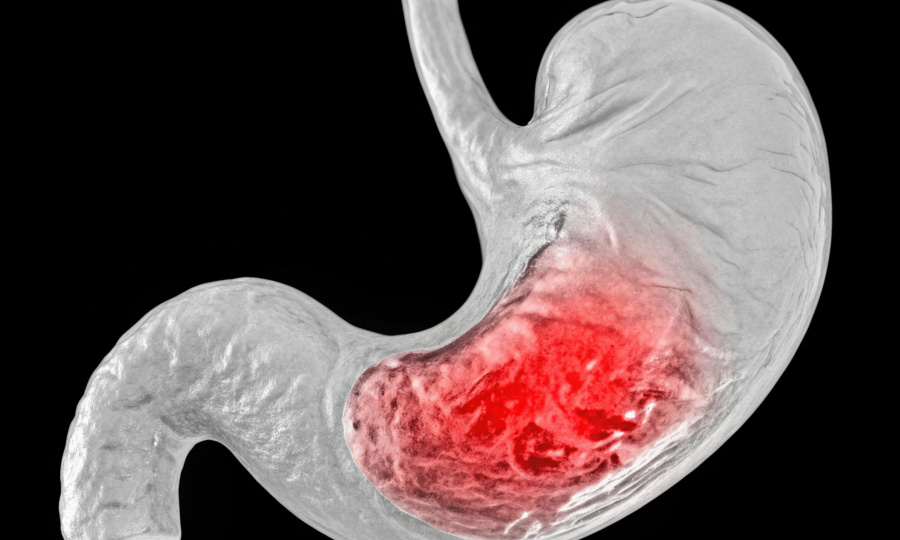 Гастрит: почему у каждого второго "больной желудок" и как с этим жить