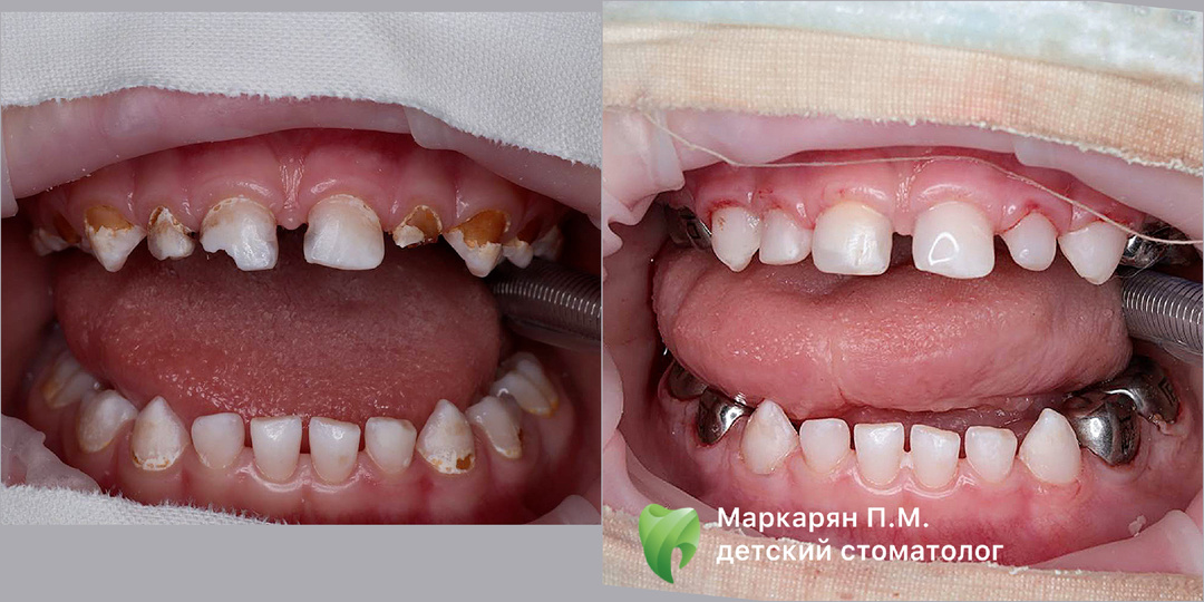 Лечени е зубов у детей под наркозом в Сочи