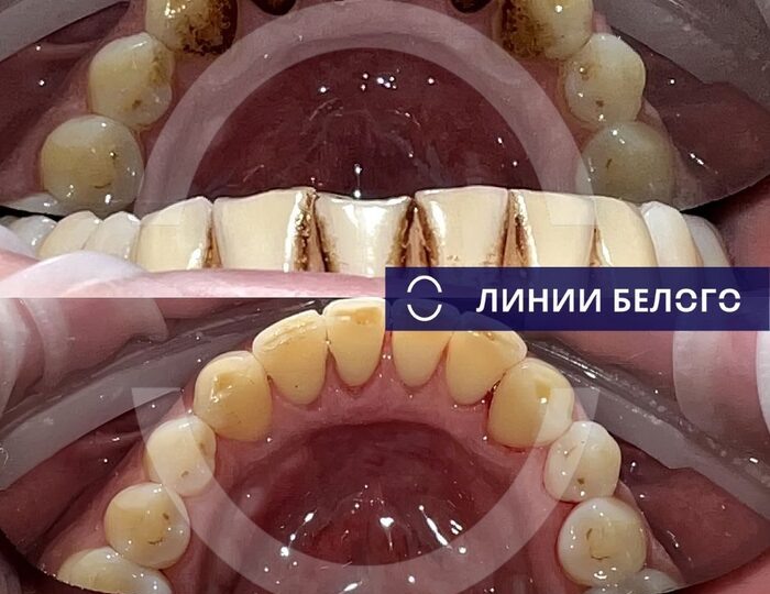 Вот почему стоматологи просят приходить раз в полгода. Смотрите сами