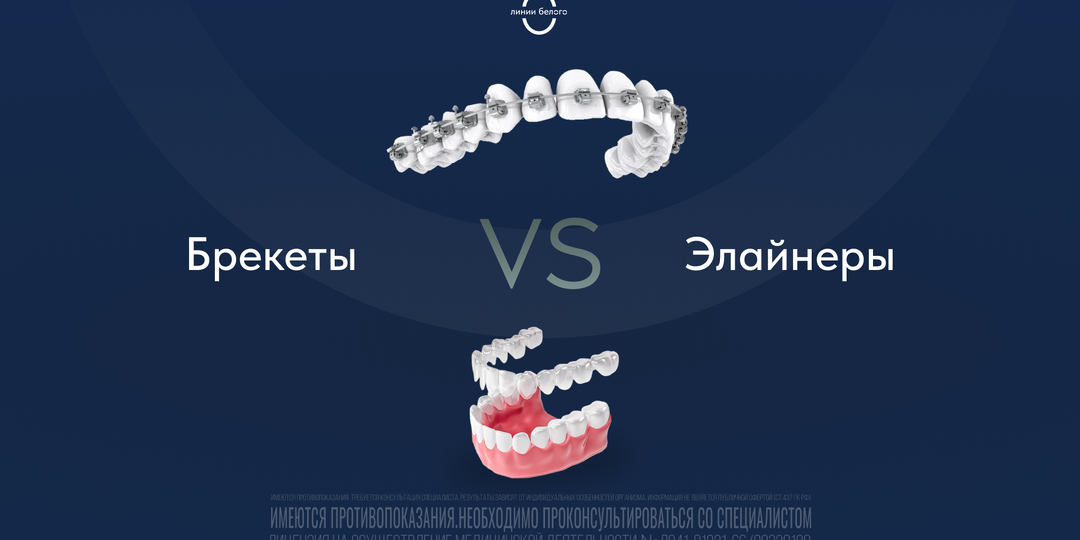 Почему одним ставят брекеты, а другим элайнеры — и это не случайность