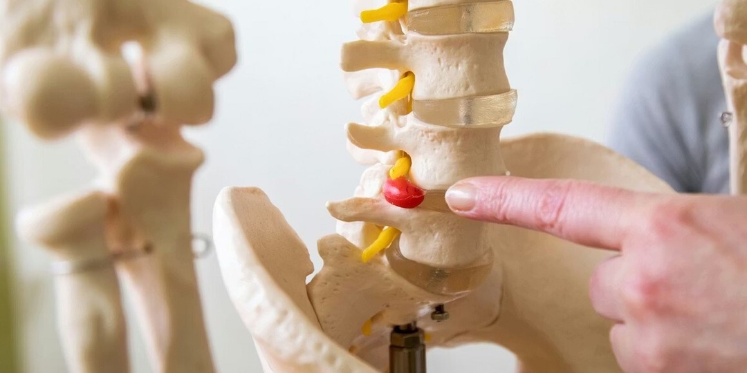 Грыжа позвоночника: 5 признаков того, что операция НЕ нужна (и 2 — когда бежать к хирургу)