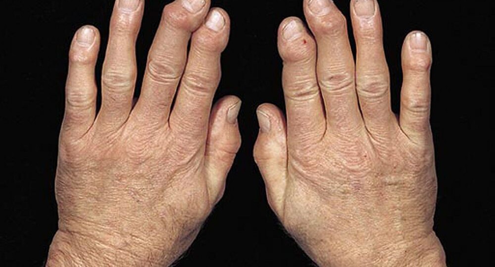 Ревматоидный артрит: когда иммунитет атакует свои суставы. Как жить, лечиться и не сломаться