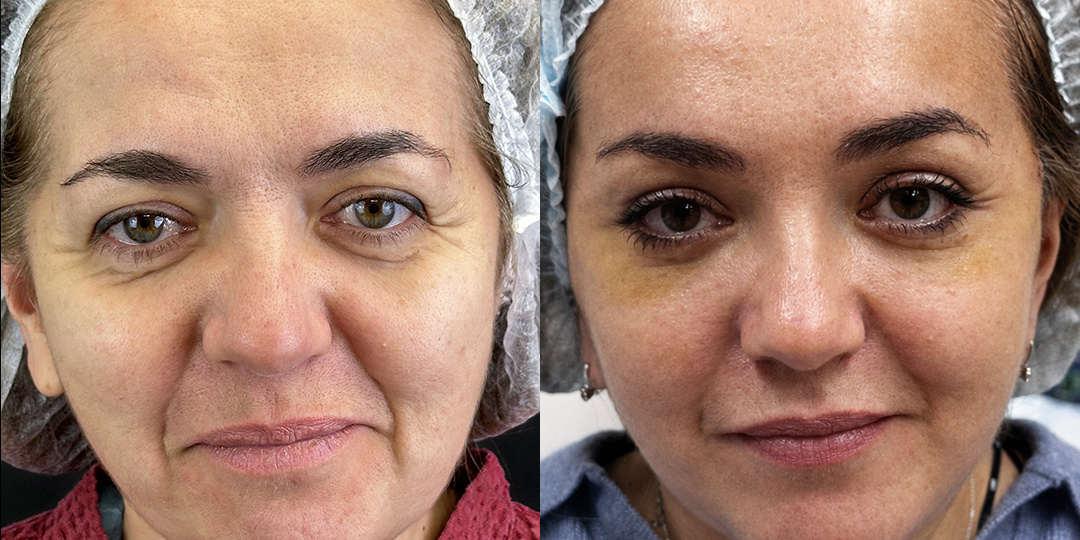 Пришла на блефаропластику. А в итоге — минус 20 лет