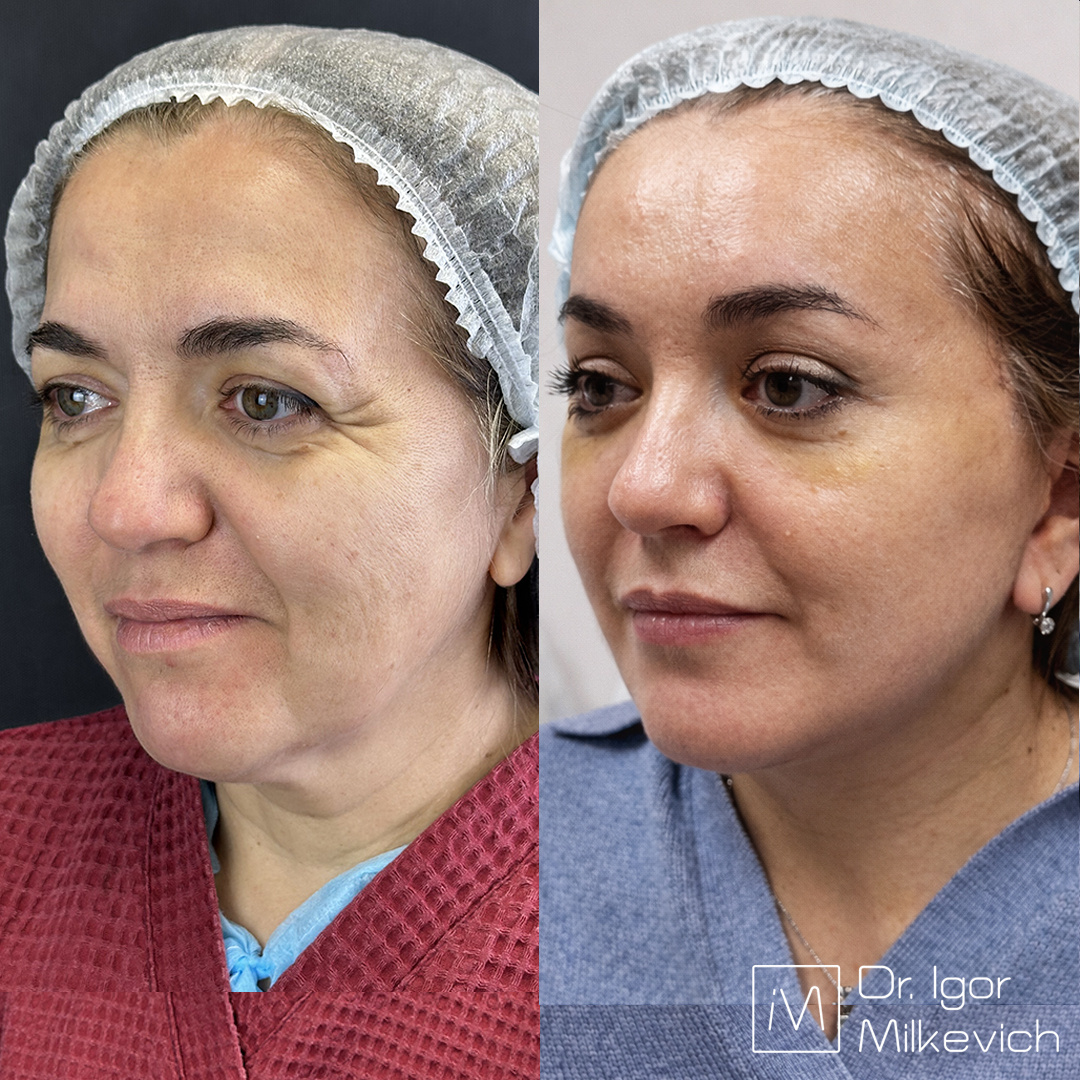 2 недели после операции