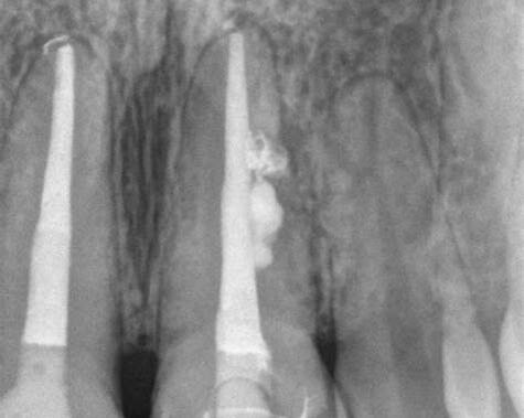 Повторное инфицирование после эндодонтического лечения