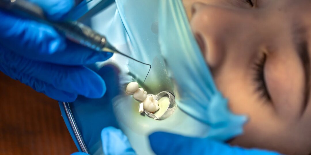 Сколько стоит лечение кариеса и от чего зависит цена