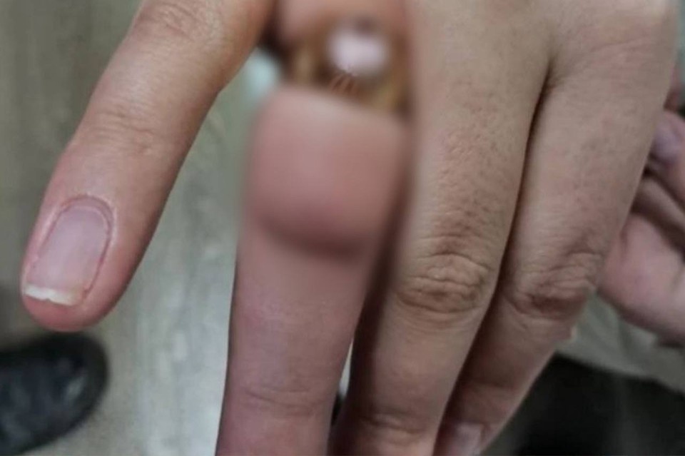    Палец серьезно отек. Фото: МАСС