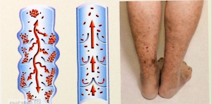 Как избежать тромбозов: Простые шаги к здоровой жизни