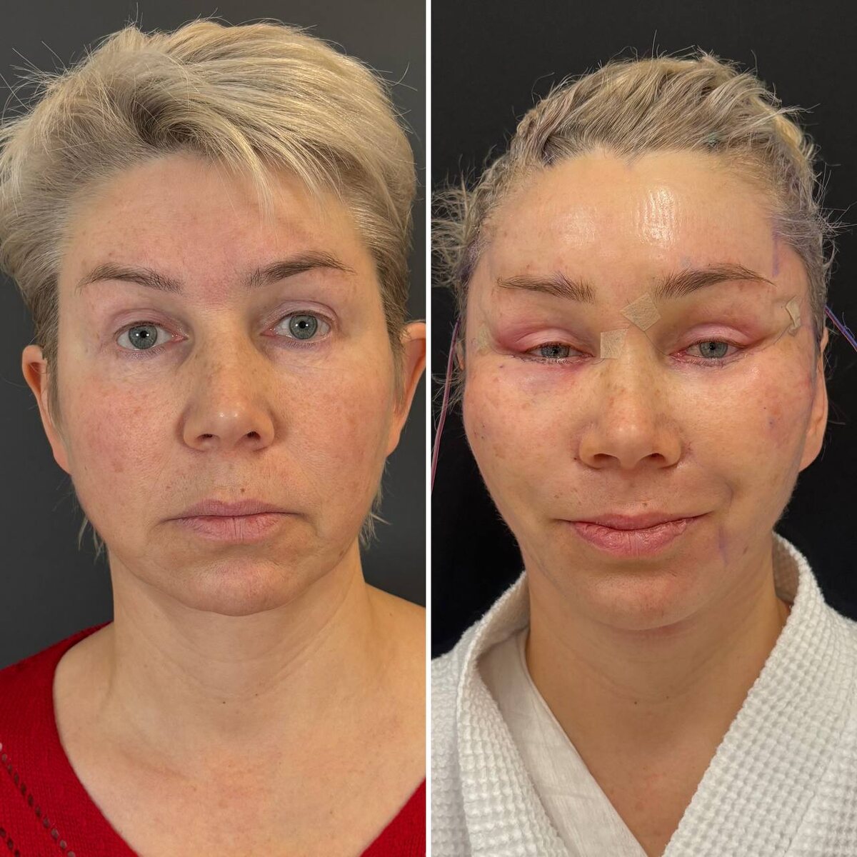 Эндоскопическая подтяжка средней зоны лица: первые сутки после операции (слева- до, справа- после). Хирург Остринская Т.В.